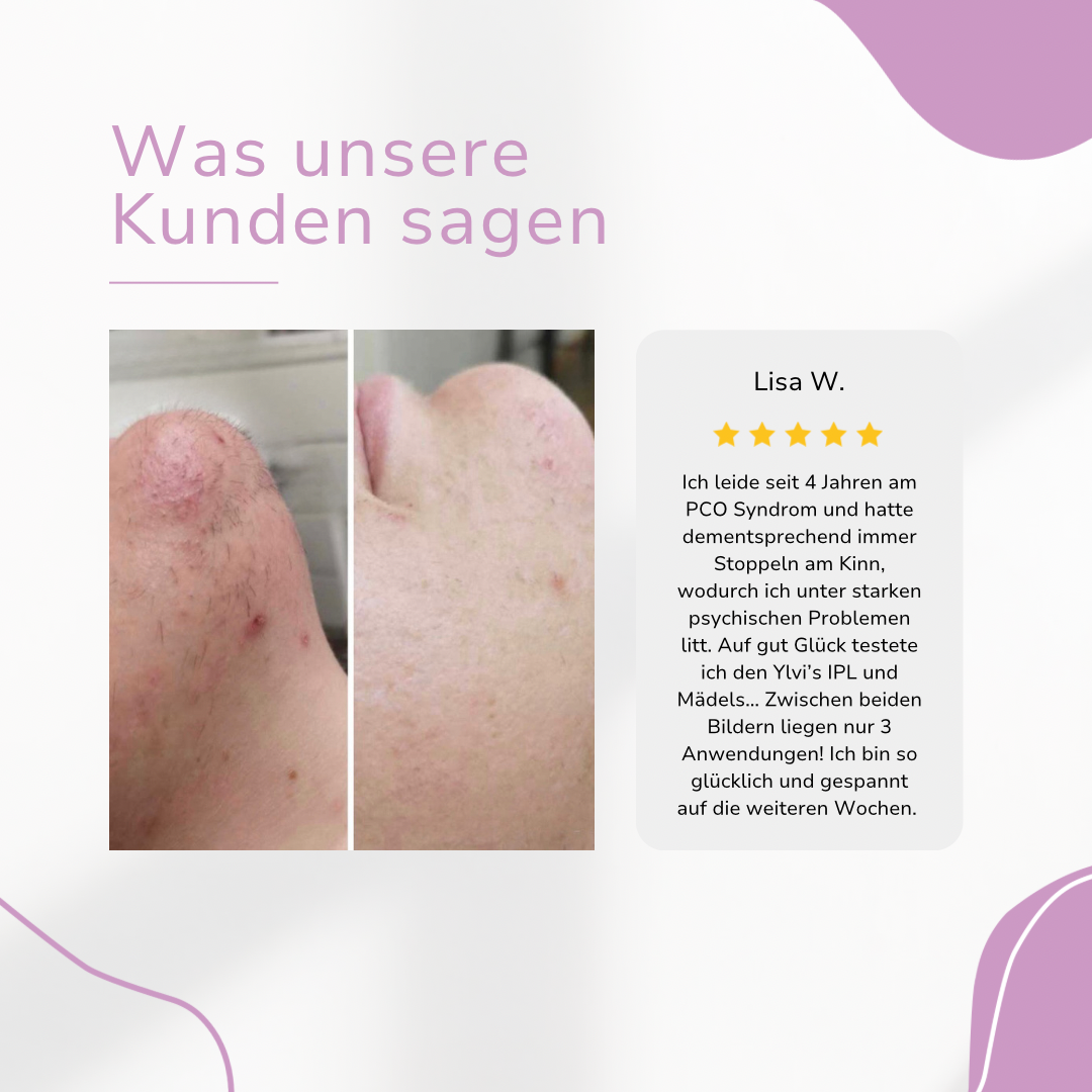 Ylvis NOVALABS Hair Remover I Die führende Laser-Haarentfernung für Zuhause