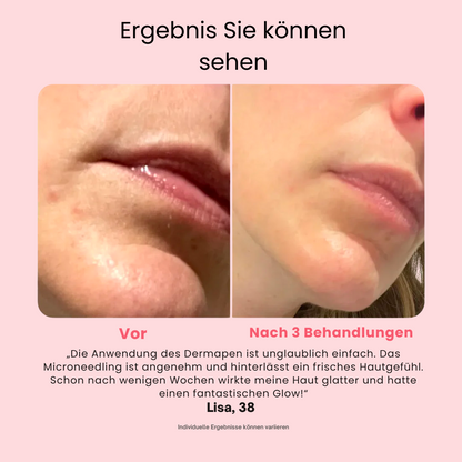Professionell wiederaufladbarer Microneedling Dermapen