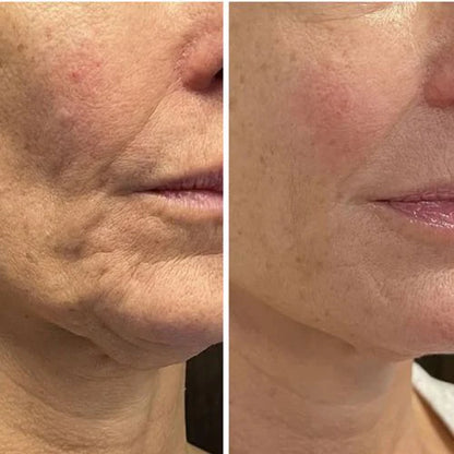 Professionell wiederaufladbarer Microneedling Dermapen
