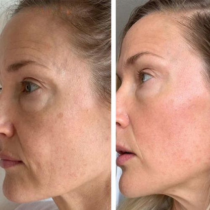 Professionell wiederaufladbarer Microneedling Dermapen