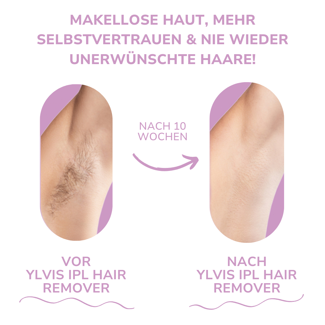 Ylvis NOVALABS Hair Remover I Die führende Laser-Haarentfernung für Zuhause
